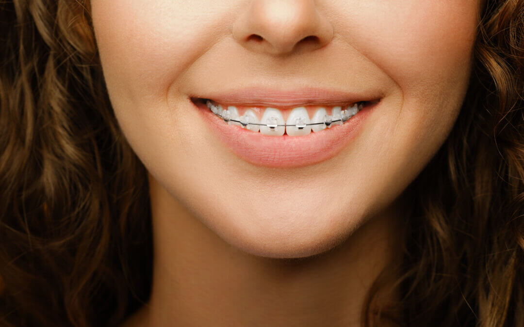 Flossing with Braces: Tips from Red Rock Orthodontics